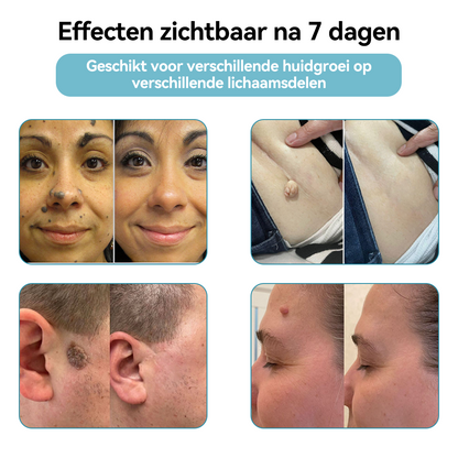 Bikenda® laserpen 💕(met CO₂-lasertechnologie – effectief voor het verwijderen van moedervlekken, wratten, huidflapjes, pigmentvlekken en andere onvolkomenheden)