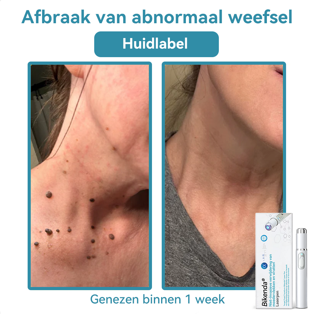 Bikenda® laserpen 💕(met CO₂-lasertechnologie – effectief voor het verwijderen van moedervlekken, wratten, huidflapjes, pigmentvlekken en andere onvolkomenheden)