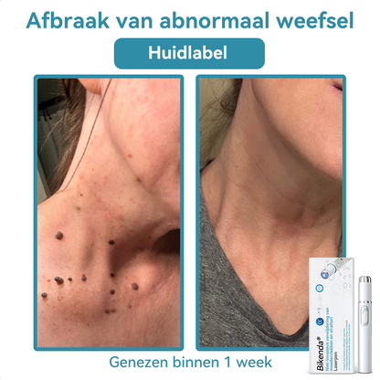 Bikenda® laserpen 💕(met CO₂-lasertechnologie – effectief voor het verwijderen van moedervlekken, wratten, huidflapjes, pigmentvlekken en andere onvolkomenheden)