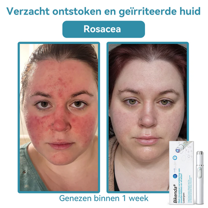 Bikenda® laserpen 💕(met CO₂-lasertechnologie – effectief voor het verwijderen van moedervlekken, wratten, huidflapjes, pigmentvlekken en andere onvolkomenheden)